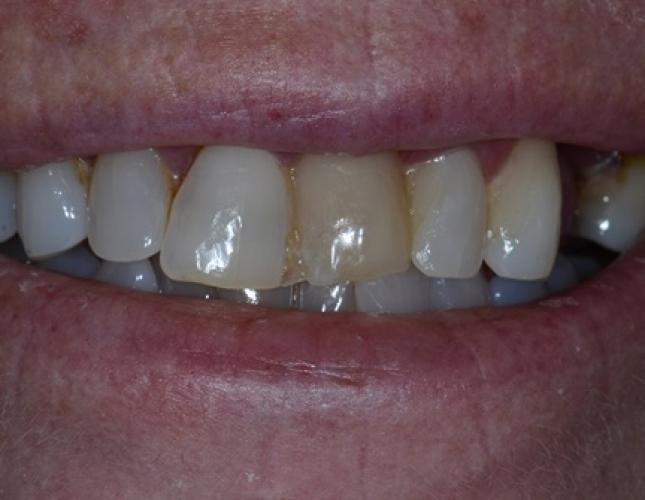 Bonnie before
