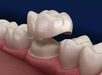 Everything You Need to Know About Dental Crowns