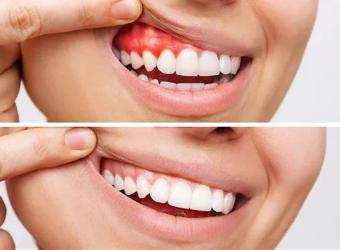 Why You Shouldn’t Ignore Bleeding Gums
