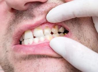 Understanding the Stages of Tooth Decay